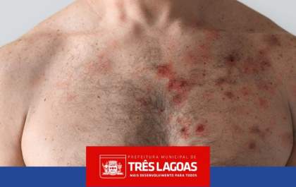 MONKEYPOX: Três Lagoas confirma novo caso da doença