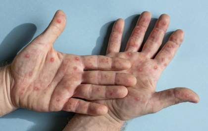 Três Lagoas registra novo caso suspeito de Monkeypox