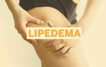 Lipedema: pouco conhecida, condição atinge cerca de 12% das mulheres