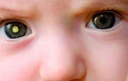 Araçatuba terá ação de prevenção ao retinoblastoma neste sábado