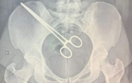 Instrumento cirúrgico é esquecido em corpo de mulher após cirurgia em Araçatuba