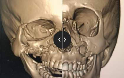 Reconstrução facial de menino de 12 anos