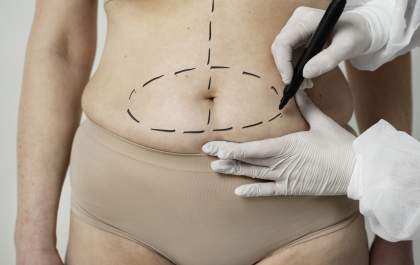Lipoaspiração: um pouco sobre passado e futuro