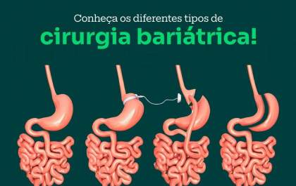 Quais são os diferentes tipos de cirurgia bariátrica? Qual o melhor?