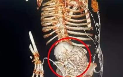 Idosa descobre que carregou feto por 56 anos