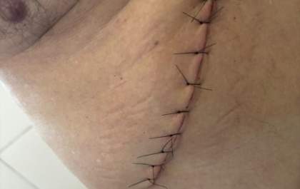 Paciente tem vesícula retirada ao ser internado para cirurgia de hemorroida na Santa Casa de Birigui