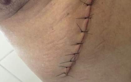 Paciente tem vesícula retirada ao ser internado para cirurgia de hemorroida na Santa Casa de Birigui