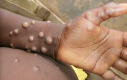 Surto de Mpox na África faz OMS declarar emergência global