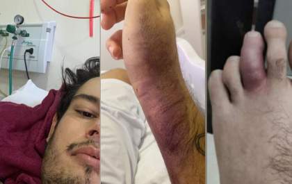 Jefferson Santana revela desafios físicos e emocionais da Síndrome de Still