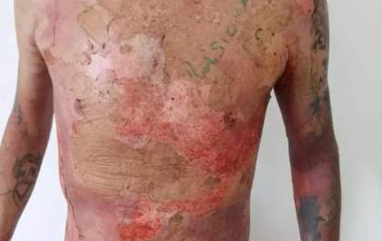 Mulher é presa por queimar vizinho com água fervente enquanto ele dormia