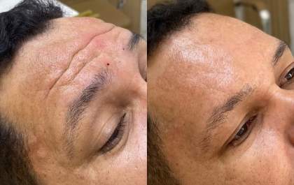 Clínica De Paula oferece aplicação de Botox com segurança em procedimentos estéticos