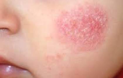 SUS passa a oferecer tratamento integral para dermatite atópica