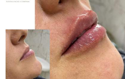 Clínica De Paula oferece preenchimento labial com naturalidade e elegância