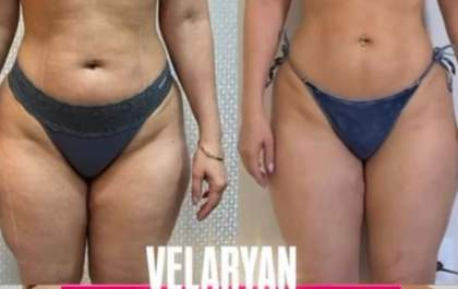 Clínica Virtuosa é a única na região com laser Velaryan para tratamento de lipedema