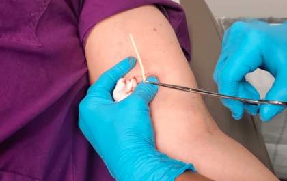 Planos de saúde passam a cobrir implante contraceptivo hormonal