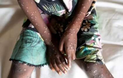 Mpox na África: quase 50 mil casos confirmados um ano após emergência global