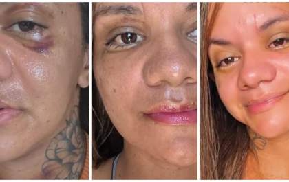 Vitória e Reconstrução: Juliana Soares Brilha Após Cirurgia Facial