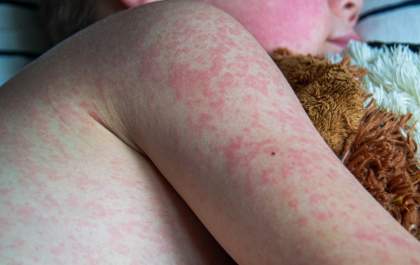 Casos de sarampo aumentam 34 vezes nas Américas, alerta Opas
