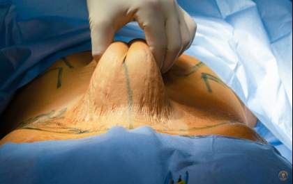 Prefeitura de Andradina terá que pagar cirurgia reparadora para mulher que fez bariátrica