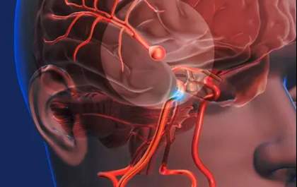 Aneurisma cerebral ainda mata 1 em cada 5 pacientes no Brasil, mas técnica moderna reduz riscos