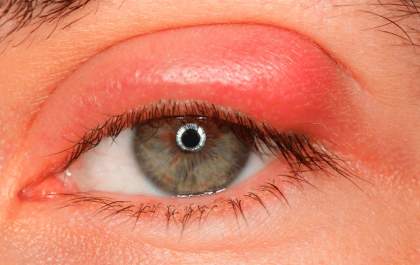 Blefarite: inflamação nas pálpebras pode afetar a saúde ocular
