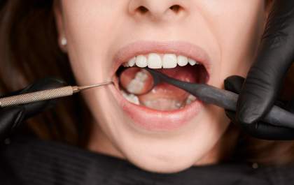 Gengiva sangrando: veja causas, cuidados e quando procurar o dentista