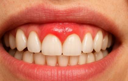Gengivas saudáveis evitam inflamações e perda dentária, destaca especialista&nbsp;
