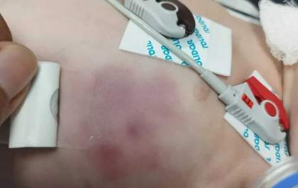 Bebê de 1 mês é internada com múltiplas fraturas nas costelas e pais são levados à delegacia