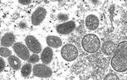 Mpox: ‘No mundo globalizado, há sempre a possibilidade da doença voltar’, alerta infectologista