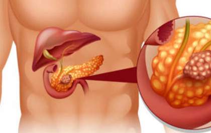 Anvisa alerta para risco de pancreatite aguda com uso indevido de canetas emagrecedoras