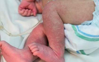 Chikungunya: 11 cidades de MS entram em situação de epidemia e estado já registra 6 mortes