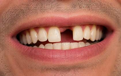 Perdeu um dente e não tratou? Veja 5 consequências para a saúde bucal