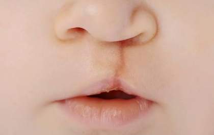 Fissura labiopalatina: projeto amplia atendimento