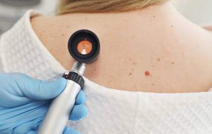 Estudo alerta para melanoma fora da pele