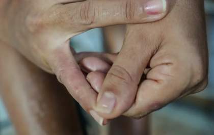 Dermatite atópica vai além das lesões na pele