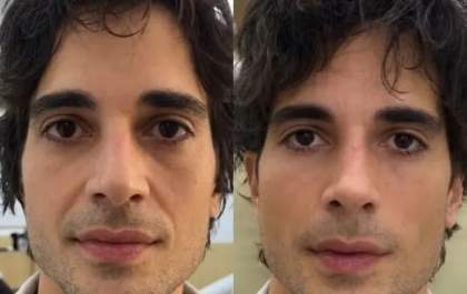 Fiuk surpreende ao revelar novo visual após harmonização facial: Tirou as noites que fiquei sem dormir