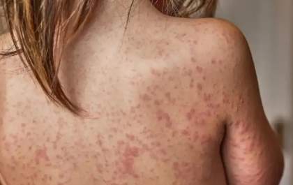 Brasil reforça alerta contra o sarampo