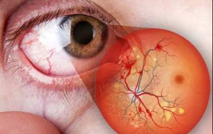 Retinopatia diabética: conheça os sinais de alerta