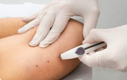 Anvisa amplia uso do Implanon de 3 para 5 anos