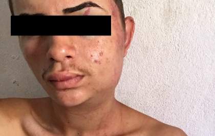 Jovem é agredido brutalmente após saída de festa universitária em Três Lagoas