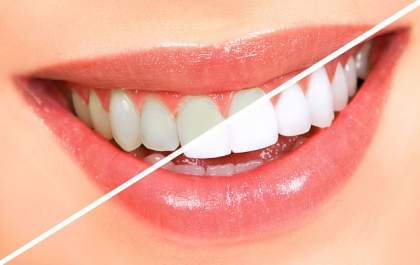 Clareamento Dental: dúvidas mais frequentes