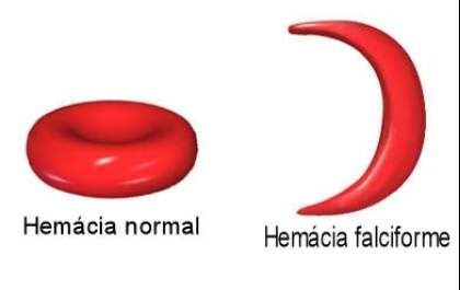 Grupo quer melhorar tratamento para quem tem anemia falciforme