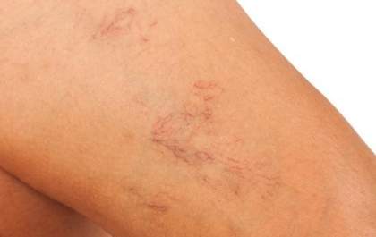 O que é a Escleroterapia para vasinhos?