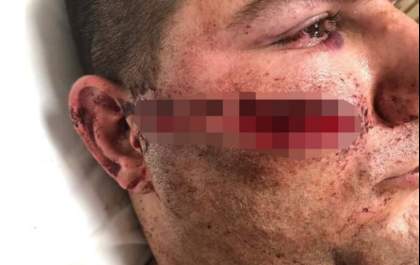 PM leva tiro no rosto ao tentar abordar motorista embriagado