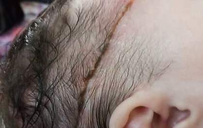Conselho de Medicina vai investigar corte em cabeça de bebê